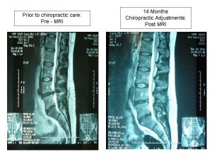 herniated disc x ray in Cary NC