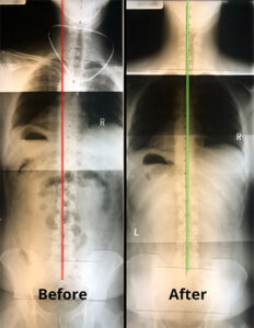 Before and After Chiropractic Adjustments at Legacy Chiropractic in Cary NC